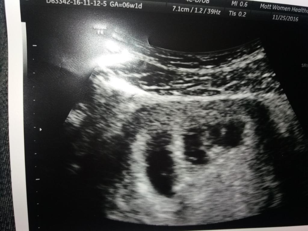 My Pregnancy Story/Miscarriage/from having triplets to singleton