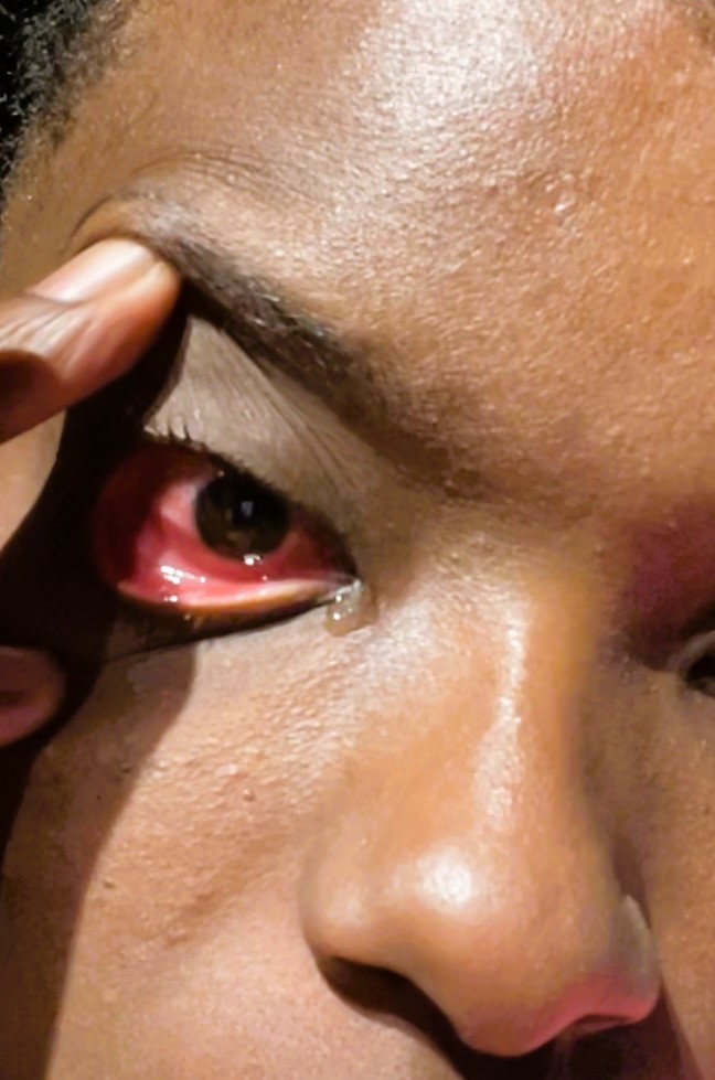 My Entire Family Got Conjunctivitis (Pink Eye)/Natural&nbsp;Remedy