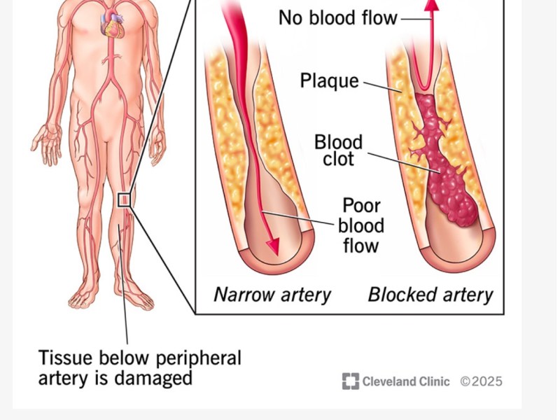 What I Learned at Church About PAD — And Why It&nbsp;Matters”