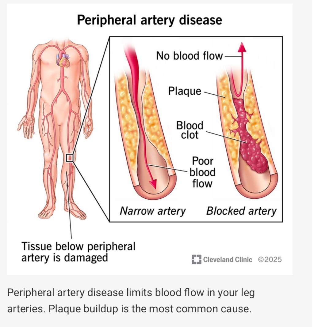What I Learned at Church About PAD — And Why It&nbsp;Matters”